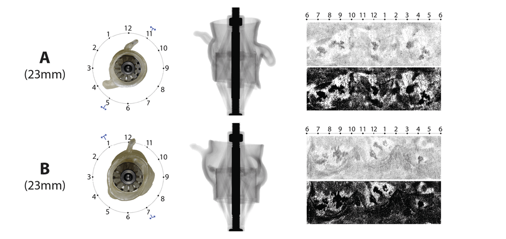 pre-procedural-fit-testing-transcatheter-aortic-valve-replacement-tavr-valves-using-parametric-modeling-3d-printing-9 pre-procedural-fit-testing-transcatheter-aortic-valve-replacement-tavr-valves-using-parametric-modeling-3d-printing-9